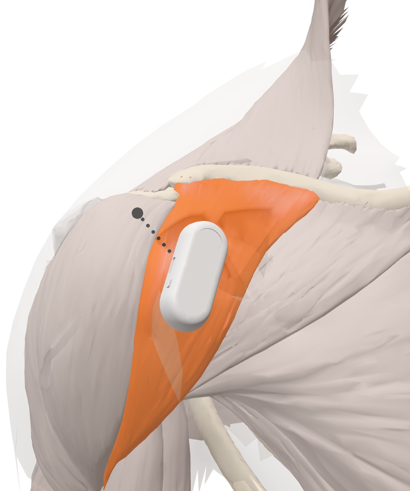 Placement du capteur Myocell sur le deltoïde antérieur vu de face, sur un modèle anatomique 3D, sous l'acromion
