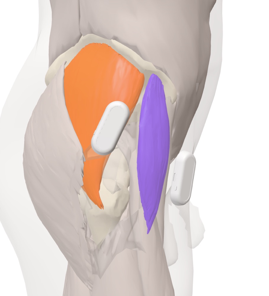 Capteurs Myocell sur le moyen fessier et le tenseur du fascia lata de la hanche droite, vue latérale sur le modèle anatomique 3D